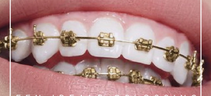 Profetie Praten tegen Onbekwaamheid Orthodontische beugels en allergieën - Comfortho, Smile Into Your Future:)