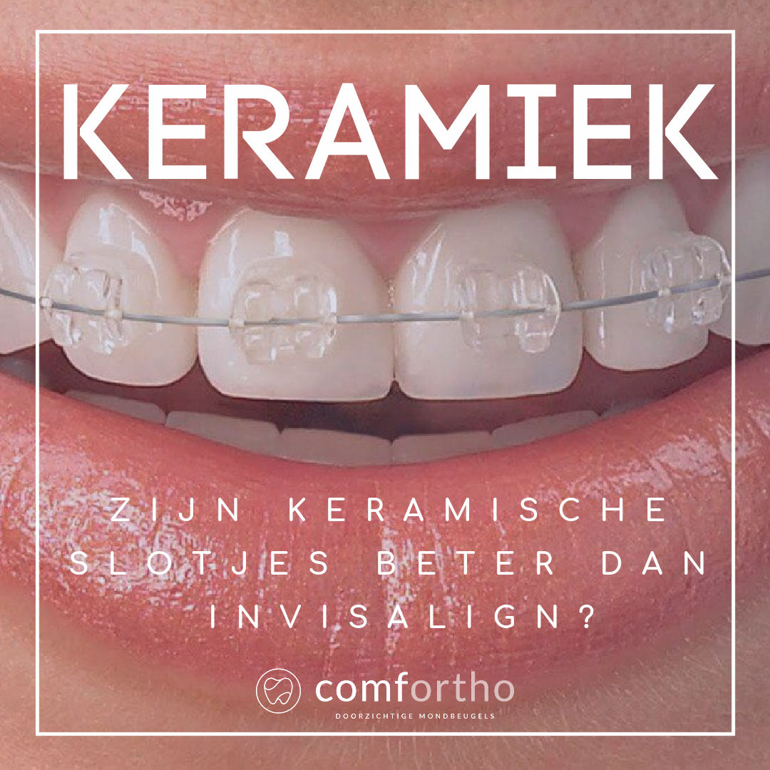 What are Ceramic braces? - Comfortho, Smile Into Your Future :)