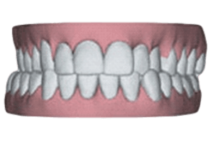 Invisible Aligners & Removable - Comfortho